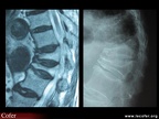 Ostéoporose : fractures vertébrales multiples