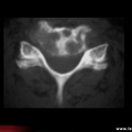 Métastase osseuse, métastase osseuse cervicale (scanner)