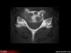 Métastase osseuse, métastase osseuse cervicale (scanner)