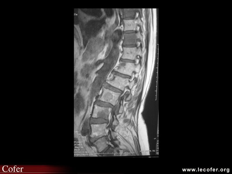 Métastases osseuses rachidiennes (cancer pancréas) : IRM