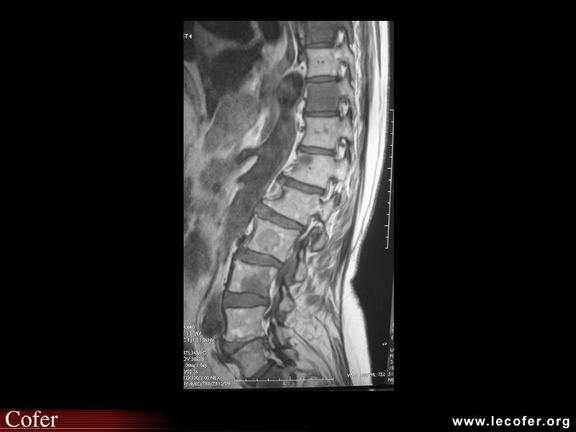Métastases osseuses rachidiennes (cancer pancréas) : IRM