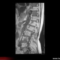 Métastases osseuses rachidiennes (cancer pancréas) : IRM