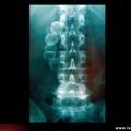 Radiographie du rachis lombaire, discarthrose L4-L5 ; découverte fortuite de lithiases