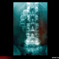 Radiographie du rachis lombaire, discarthrose L4-L5 ; découverte fortuite de lithiases
