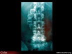Radiographie du rachis lombaire, discarthrose L4-L5 ; découverte fortuite de lithiases