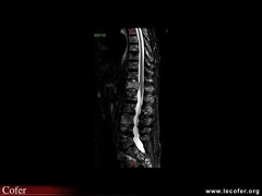 Myélome multiple, aspect IRM du rachis dans le myélome multiple