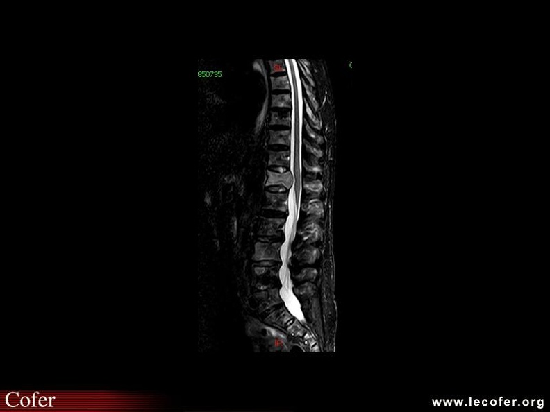 Multiples lésions ostéolytiques et nodulaires du rachis (hypersignal T2) dans un myélome multiple ; atteinte diffuse de T12 avec bombement postérieur sans envahissement de l'espace épidural. 000000000672s.jpg