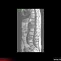 Myélome multiple, aspect IRM du rachis dans le myélome multiple