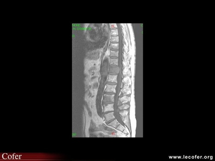 Myélome multiple, aspect IRM du rachis dans le myélome multiple