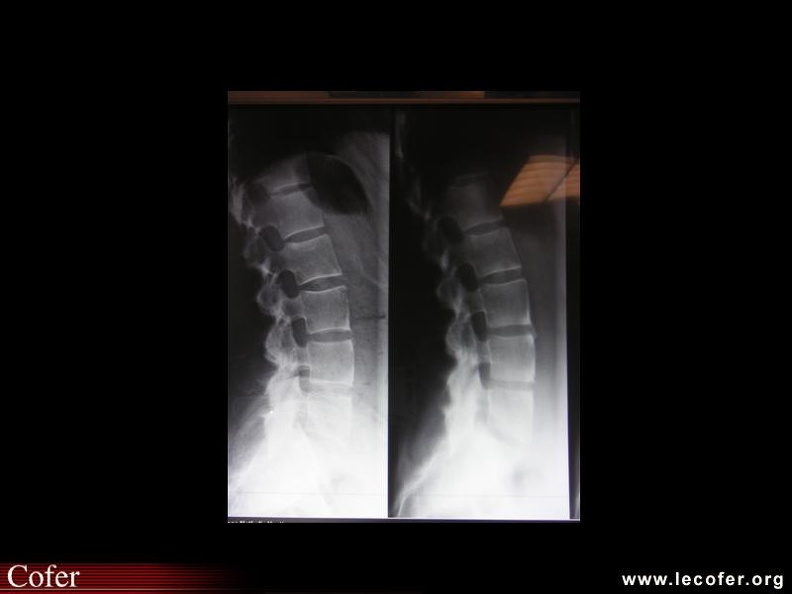 Spondylarthrite ankylosante, spondylarthropathie, SpA ...