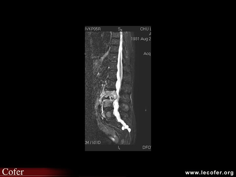 Spondylodiscite à staphylococcus aureus