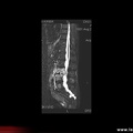 Spondylodiscite à staphylococcus aureus