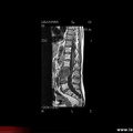 Spondylodiscite à staphylococcus aureus