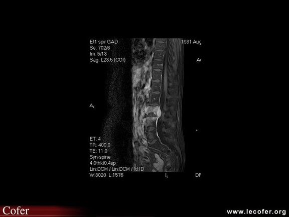 Spondylodiscite à staphylococcus aureus