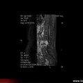 Spondylodiscite à staphylococcus aureus