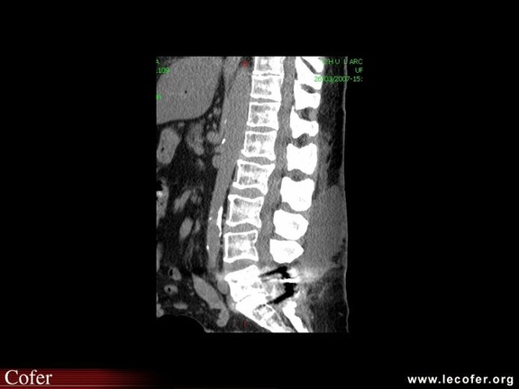 Spondylodiscite, collection infectée dans les parties molles lombaires