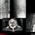 Métastases osseuses vertébrales