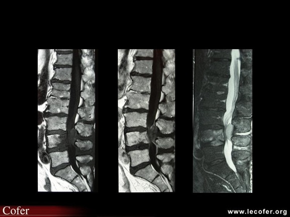 Lymphome épidural