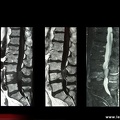 Lymphome épidural