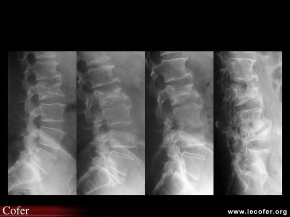 Spondylodiscite septique L3-L4