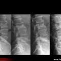 Spondylodiscite septique L3-L4