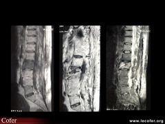 Spondylite abcédée de L2