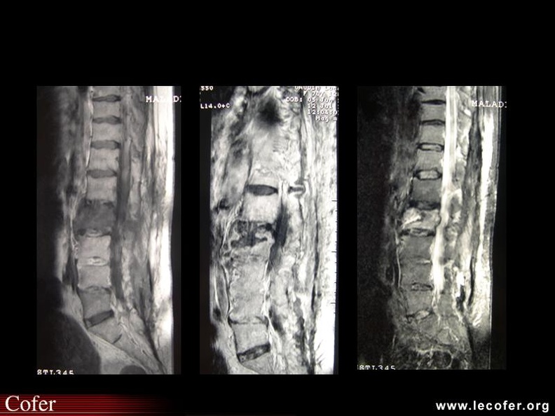 Spondylite abcédée de L2. 000000000805s.jpg