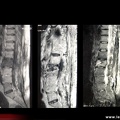 Spondylite abcédée de L2