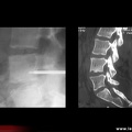 Spondylarthrite ankylosante, spondylite de L4