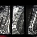 Spondylarthrite ankylosante, spondylite de L4