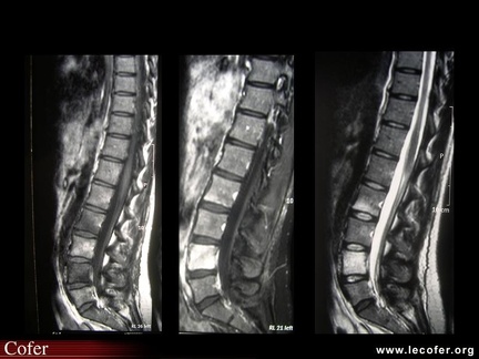 Spondylarthrite ankylosante, spondylite de L4