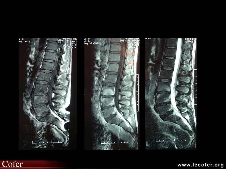 Spondylarthrite ankylosante | Diapothèque du COFER