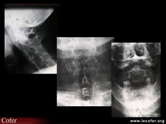 Spondylarthrite ankylosante