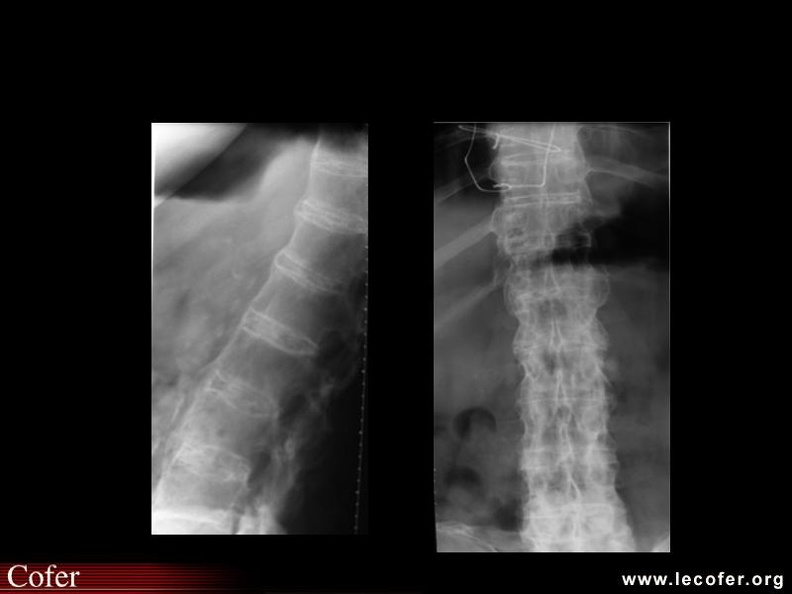 Spondylarthrite ankylosante