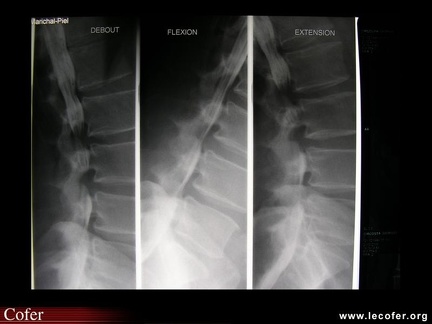 Canal lombaire rétréci, saccoradiculographie : rétrécissement du canal lombaire sur plusieurs étages
