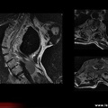 Diastématomyélie et scoliose