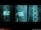 Métastase vertébrale, métastase osseuse : radiographies, radios