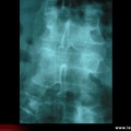 Métastase osseuse : radiographies, radios