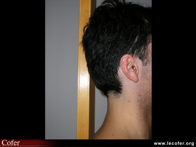 Mesure occiput / toise. Patient normal de profil