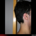 Mesure occiput / toise. Patient normal de profil