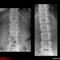 Spondylarthrite ankylosante / SpA / pelvispondylite rhumatismale / spondylarthropathie : syndesmophytes de face