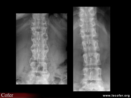 Spondylarthrite ankylosante / SpA / pelvispondylite rhumatismale / spondylarthropathie : syndesmophytes de face