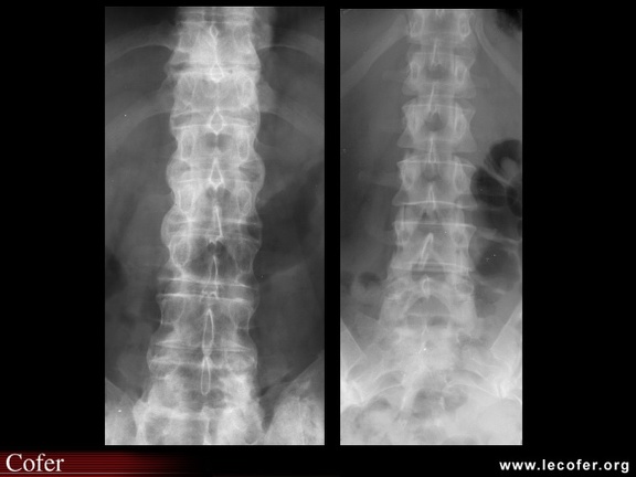 Spondylarthrite ankylosante / SpA / pelvispondylite rhumatismale / spondylarthropathie : syndesmophytose étendue de face