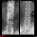 Spondylarthrite ankylosante / SpA / pelvispondylite rhumatismale / spondylarthropathie : syndesmophytose étendue de face