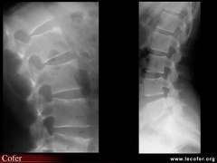 Spondylarthrite ankylosante / SpA / pelvispondylite rhumatismale / spondylarthropathie