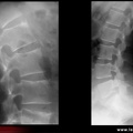 Spondylarthrite ankylosante / SpA / pelvispondylite rhumatismale / spondylarthropathie