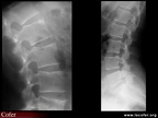 Spondylarthrite ankylosante / SpA / pelvispondylite rhumatismale / spondylarthropathie