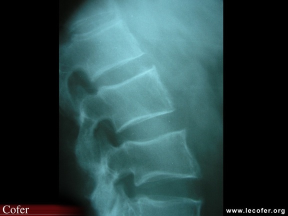 Spondylarthrite ankylosante / SpA / pelvispondylite rhumatismale / spondylarthropathie : mise au carré des vertèbres