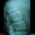 Spondylarthrite ankylosante / SpA / pelvispondylite rhumatismale / spondylarthropathie : mise au carré des vertèbres