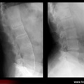 Spondylarthrite ankylosante / SpA / pelvispondylite rhumatismale / spondylarthropathie